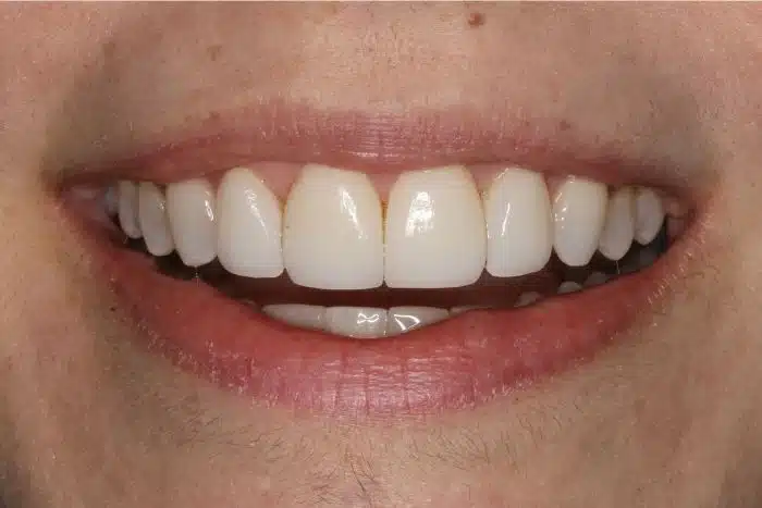 Smile Makeover With Invisalign & Veneers