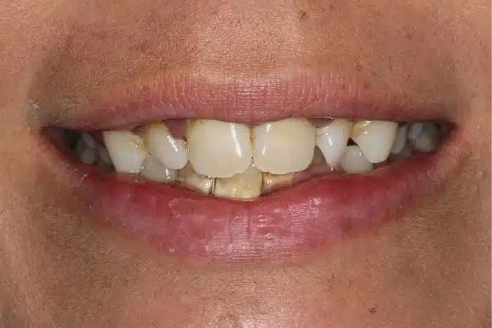 Smile Makeover With Invisalign & Veneers