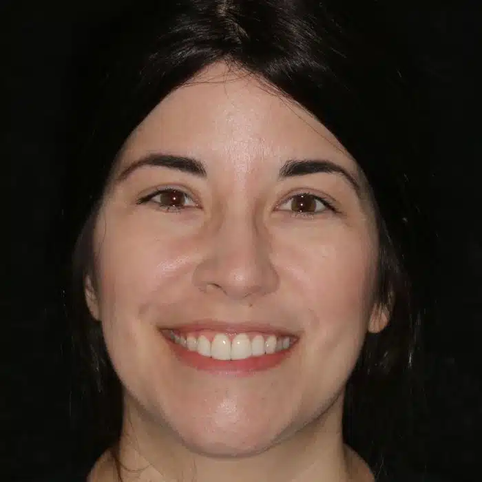 Smile Makeover With Invisalign & Veneers