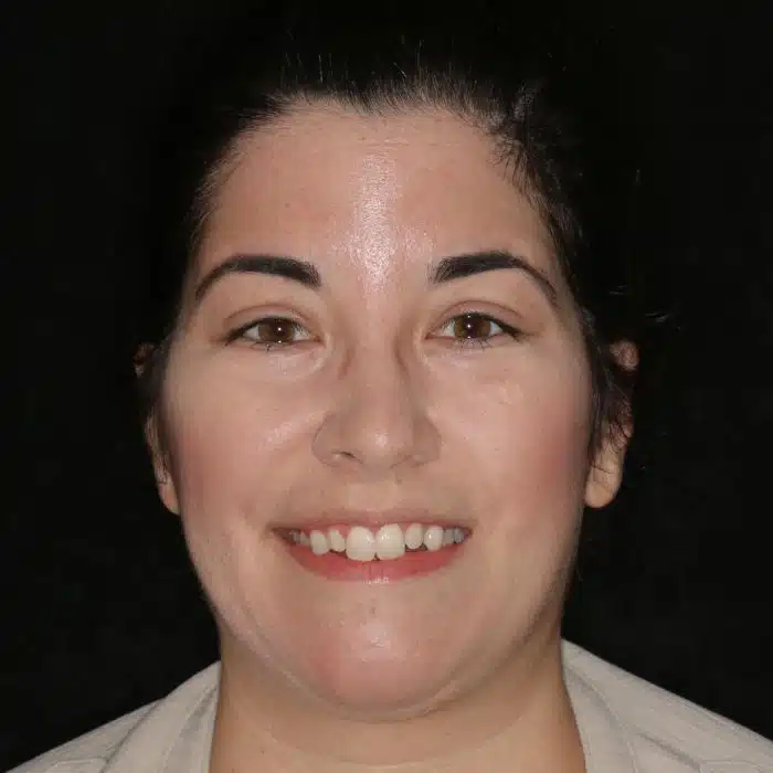 Smile Makeover With Invisalign & Veneers